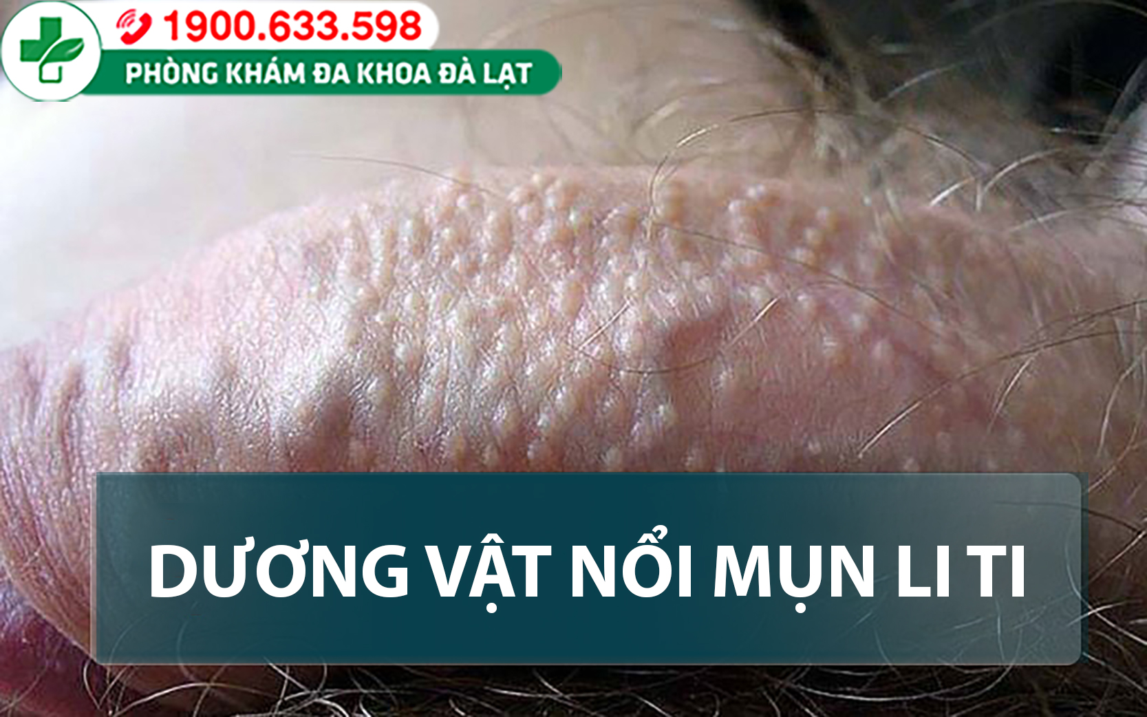 Nguyên nhân dương vật nổi mụn liti và cách điều trị